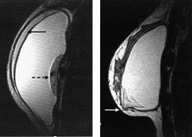 Figur 7    a) T2-vektet bilde i sagittalplan av dobbeltlumenprotese. Det ytre lumen er silikonfylt (heltrukket pil), det&hellip;