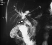 Figur 3    Magnetisk resonanstomografisk kolangiopankreatikografisk bilde av stein i ductus hepaticus communis. Steinen blir&hellip;