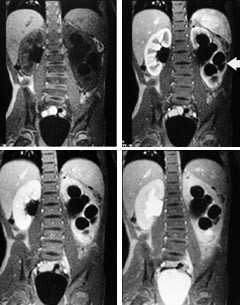 Figur 5    Ni &aring;r gammel gutt med venstresidig overgangsstenose. T1-vektet dynamisk unders&oslash;kelse i koronalplan.  a) F&oslash;r&hellip;