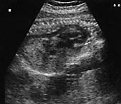 Figur 2    Ultralydbilde (lengdesnitt) av foster med forst&oslash;rret hjerte (pil) og utvidet aorta