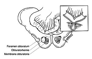  Figur 1    Obturatorhernie. Illustrasjon K. Toverud