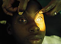 Ung gutt som har v&aelig;rt blind i ti &aring;r f&oslash;r han ble operert for medf&oslash;dt gr&aring; st&aelig;r