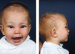  Figur 5    Pasient 2 tre m&aring;neder etter at hun ble operert av kraniofacialteamet