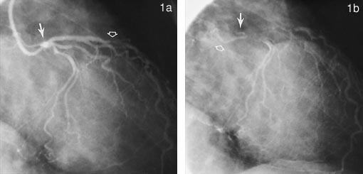  Figur 1a    Koronarangiografi av pasient 1. Fremre h&oslash;yre skr&aring;projeksjon med kontrastinjeksjon i venstre koronararterie&hellip;
