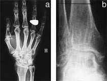 Figur 3    Pasient 2.  a) R&oslash;ntgenbilde av h&oslash;yre h&aring;nd med cystiske oppklaringer i mange av h&aring;ndrotsknoklene, dessuten distalt&hellip;