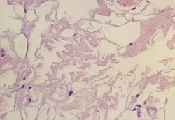 Figur 4    Pasient 2. Beinmargsbiopsi fra falang. Materialet har en nettverksliknende oppbygging med uregelmessige&hellip;