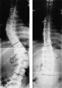 Figur 3  R&oslash;ntgen af skoliose f&oslash;r og efter operation med moderne tostavsteknik