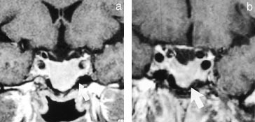  Figur 4    56 &aring;r gammel mann med akromegali. T1-vektede koronale snitt etter kontrast. a) Preoperativt bilde viser&hellip;