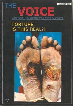 Alvorlige fotskader hos kenyaneren Chacole Olo etter at han ble torturert i tre dager av politiet og storvilttilsynet&hellip;