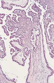  Figur 2    Borderline papill&aelig;r ser&oslash;s eggstokktumor. Fine forgrenede papiller er dekket av atypiske ser&oslash;se epitelceller som&hellip;