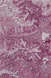  Figur 3    Mucin&oslash;s borderline eggstokktumor. Flere cyster er dekket med prolifererende atypiske mucin&oslash;se epitelceller&hellip;