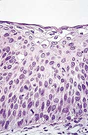  Figur 1    Portiobiopsi med h&oslash;ygradig cervikal intraepitelial neoplasi og HPV-forandringer med koilocytose i &oslash;vre cellelag