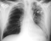  Figur 3    Kontrollbilde fem dager etter p&aring;begynt erytromycinbehandling. Tilbakegang av lungeinfiltrater