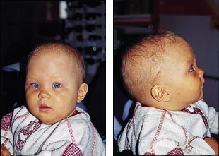  Figur 5    Pasient 2 tre m&aring;neder etter operasjon