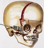  Figur 3    Illustrasjon av kraniet etter en monoblokkoperasjon hvor panne og ansiktsskjelett l&oslash;snes. Distraksjonsapparat er&hellip;