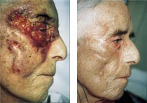  Figur 2    a) Et lite kutt p&aring; kinnet til en 92 &aring;r gammel kvinne utviklet seg raskt til et s&aring;r som ikke grodde som forventet&hellip;