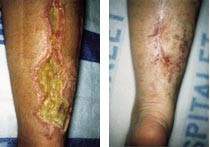  Figur 3    a) 16 &aring;r gammel pike fikk utf&oslash;rt et operativt inngrep p&aring; h&oslash;yre legg. F&aring; dager etter inngrepet utviklet det seg&hellip;