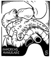  Figur 1    Pancreas annulare. Pancreashodet omslutter duodenum ringformet og kan for&aring;rsake stenose