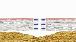  Figur 11    Underminering mellan dermis och subcutis f&ouml;r att underl&auml;tta suturering av s&aring;rkanterna utan tension