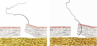  Figur 15 a, b    Enkel sutur. Suturn&aring;len sticks vinkelr&auml;tt genom hudens yta och s&auml;tts s&aring; n&auml;ra s&aring;rkanten som m&ouml;jligt med ett&hellip;