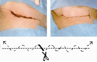  Figur 22 a &ndash; c    Intrakutan sutur sydd med ett ytligt omtag, som underl&auml;ttar suturtagning