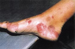 Vesikler og bullae ved porfyria cutanea tarda. Foto S. Sandberg