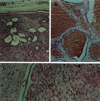  Figur 4    Lysmikroskopisk unders&oslash;kelse av svulster vist i figur 3. Samtlige preparater er farget med hematoksylin og eosin&hellip;