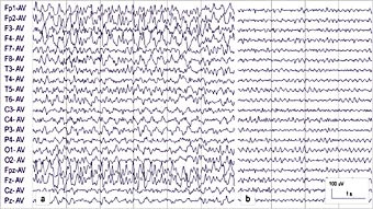  Figur 1    Pasient 1.  a) EEG under ikke-konvulsiv status epilepticus viser langsom aktivitet med tilkoblede rytmiske&hellip;