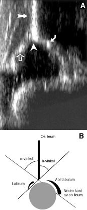  Figur 1    a) Ultralydbilde av normalt hofteledd hos nyf&oslash;dt. Koronalt snitt gjennom midtre del av acetabulum, standard&hellip;