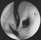  Figur 7    Endoskopisk bilde av vomeronasale groper p&aring; h&oslash;yre side hos et voksent menneske. Det er brukt metylenbl&aring;tt som&hellip;