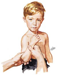 Reponeringsman&oslash;ver for &laquo;pulled elbow&raquo;, dvs. subluksasjon av radiushodet