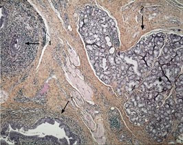  Figur 2    Histologisk snitt fra den forgrenede proksimale del av ductus thyreoglossus (pil 1) med spyttkjertelvev av muk&oslash;s&hellip;