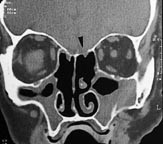  Figur 3    Fra en CT-unders&oslash;kelse sju uker etter operasjonen (koronalt 5/10 snitt). Den intrakraniale luften er helt&hellip;