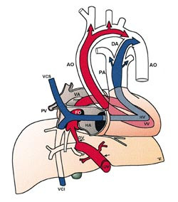  Figur 2    Den sentrale fostersirkulasjonen med via sinistra (r&oslash;dt) og via dextra (bl&aring;tt) hos mennesket. Via sinistra f&oslash;rer&hellip;