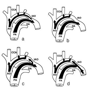  Figur 5    Det meste av blodet i fosterets pulmonalarterie (PA) ledes gjennom ductus arteriosus (DA) til nedadstigende&hellip;