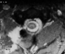  Figur 2    Aksialt T2-vektet MR-bilde i C1/C2-niv&aring; som viser durarift med lekkasje av cerebrospinalv&aelig;ske ut i bl&oslash;tvev p&aring;&hellip;