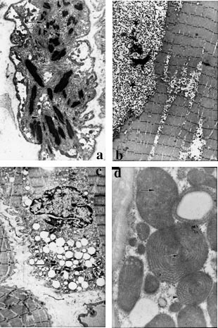  Figur 2    Biopsier fra skjelettmuskulatur. a) Nemalinlegememyopati. Elektronmikroskopisk bilde av muskelcelle med&hellip;