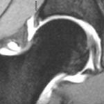 Figur 4  MR-artrogram med koronal gradientekko T1-vektet fettsuppressjonssekvens viser manglende fremstillig av recessen,&hellip;