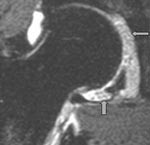 Figur 7  MR-artrogram med koronal short T1 recovery-sekvens viser et ledd fylt med multiple frie legemer og hypertrofisk&hellip;