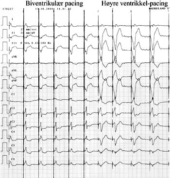 Figur 5  12 avledningers EKG-registrering under biventrikul&aelig;r og h&oslash;yre ventrikkel-pacing av pasient 1. Man ser endringen av&hellip;