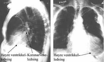 Figur 6  R&oslash;ntgen thorax av pasient 1 etter fire m&aring;neder med biventrikul&aelig;r pacing. For sammenlikning se figur 4