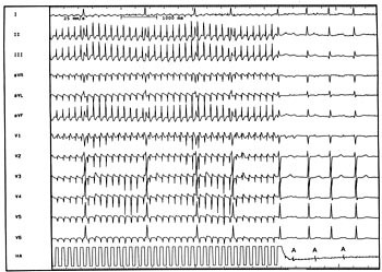 Figur 2  Type I-atrieflutter. Ved hurtig stimulering i h&oslash;yre atrium (20 &ndash; 30 % over den spontane atriefrekvens) fanges&hellip;