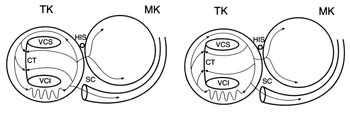 Figur 3  Trikuspidal (TK)- og mitralklaffene (MK), v. cava superior (VCS) og inferior (VCI) og sinus coronarius (SC)&hellip;