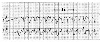 Figur 4  EKG-registrering fra pasient under behandling med flekainid. Blokkert atrieflutter g&aring;r over til 1 : 1 overledet&hellip;