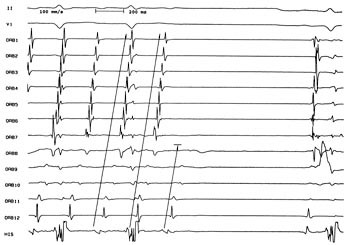 Figur 4  Radiofrekvensablasjon av typisk atrieflutter med 2 : 1 atrioventrikul&aelig;r overledning. I venstre del av figuren&hellip;