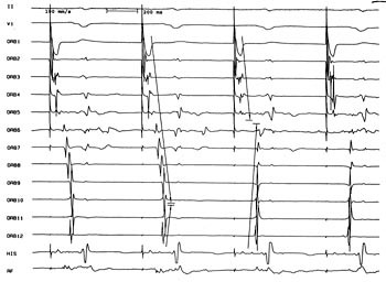 Figur 5  Hjertestimulering fra sinus coronarius med frekvens 100 per minutt. Registreringen viser impulsutbredelsen f&oslash;r det&hellip;