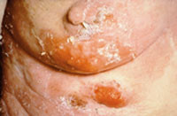 Figur 2  Morbus Paget