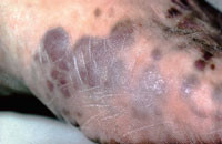 Figur 3  Kaposis sarkom