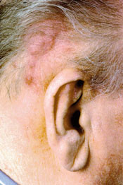 Figur 4  Angiosarkom