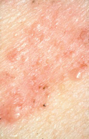 Figur 6  Ytligt basaliom